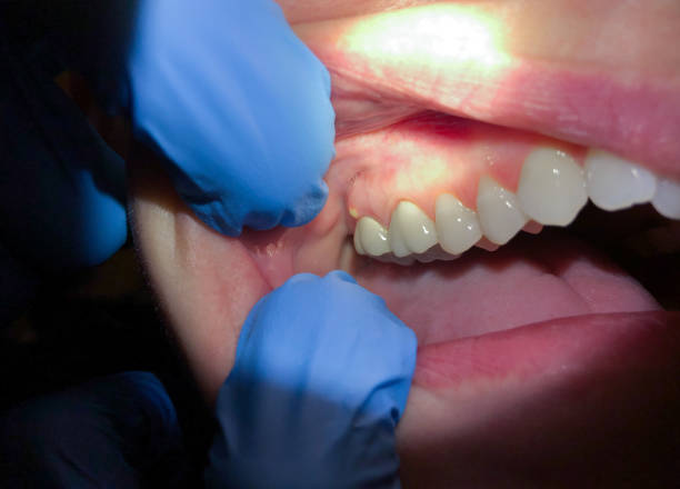 Teeth Whitening in OK